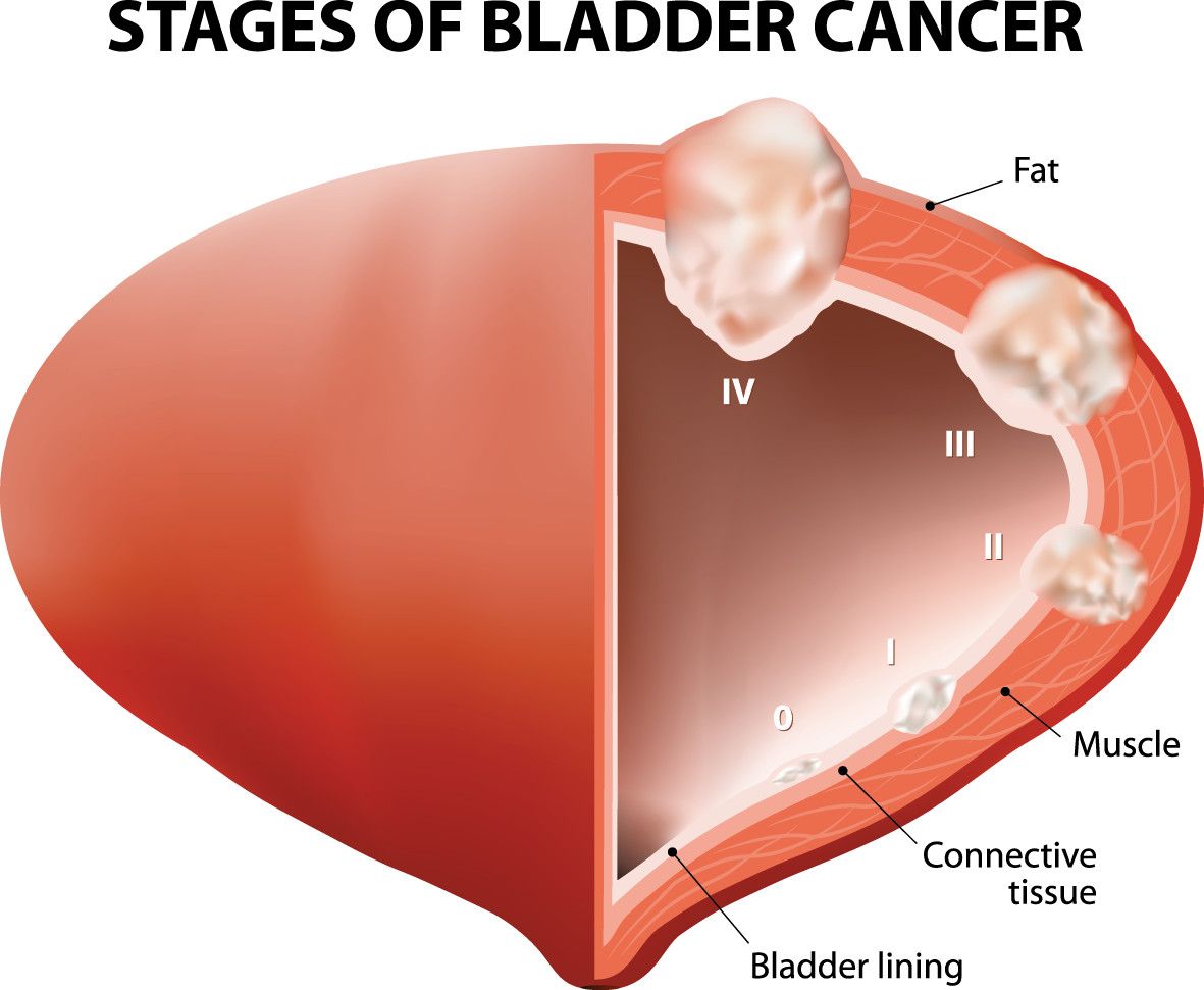 Bladder Cancer: Staging