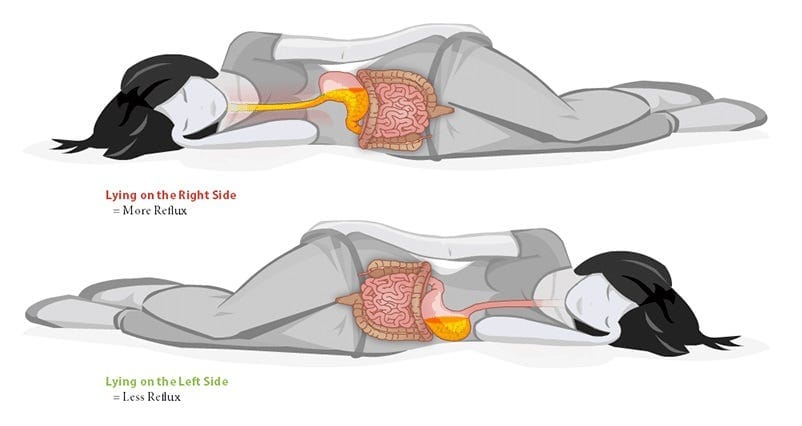 Left or Right Side Sleeping Position